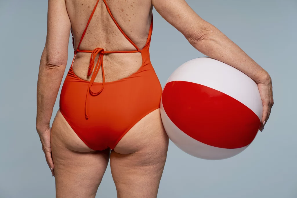 types de cellulite femme
