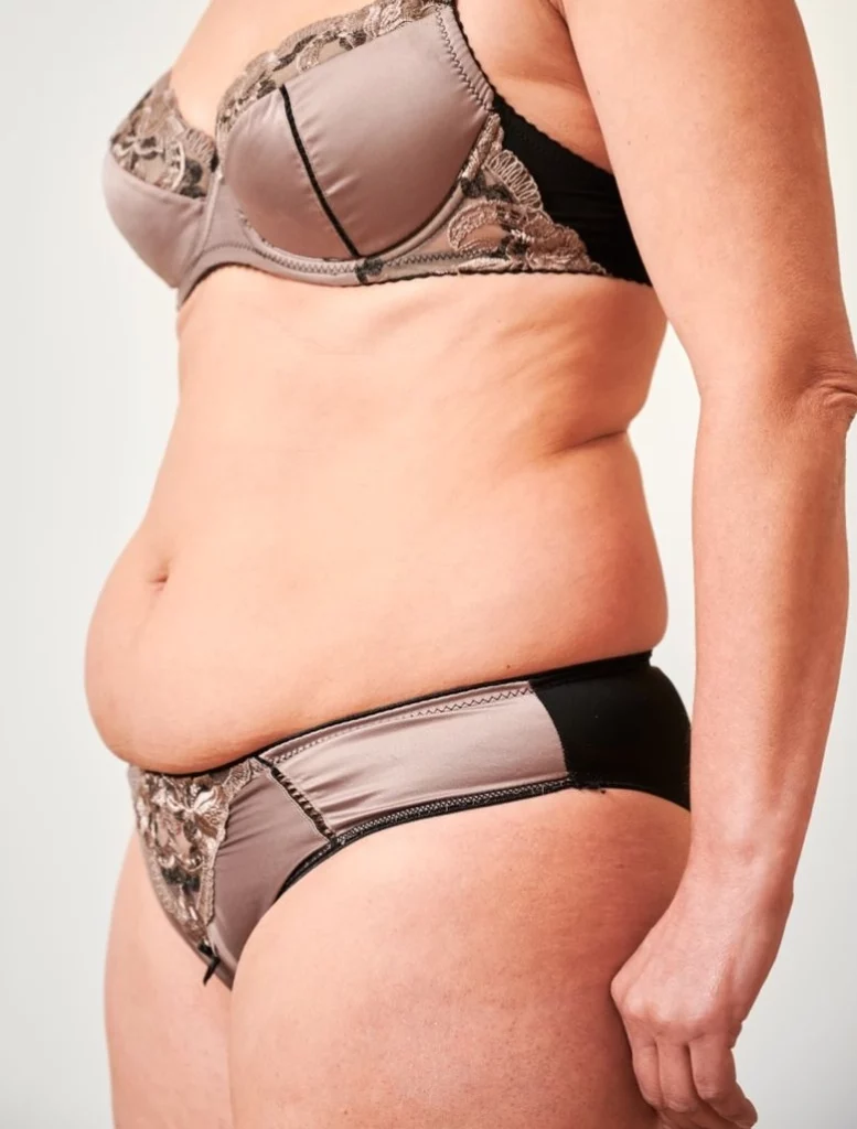 Avant/Après_Cryolipolyse